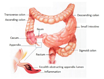 fecalith obstructing appendix lumen