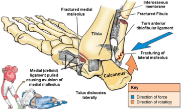 Fractured fibula