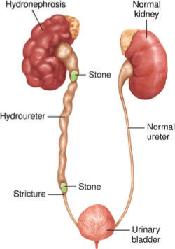 kidney stones in ureter