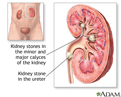 kidney with stones