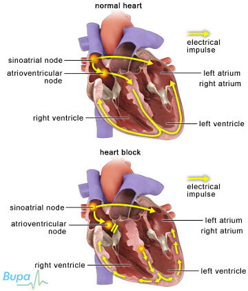 comparison of normal heart to heart with a heart block